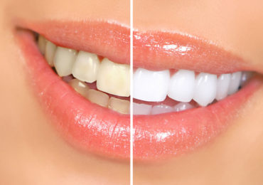 Teeth_beforeafter-370x260 milpitas cosmetic dentist