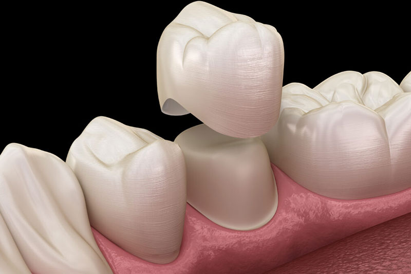 Dental Crowns in Milpitas