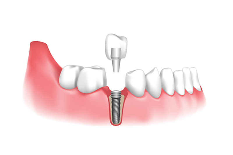 Implant Dentist in Milpitas